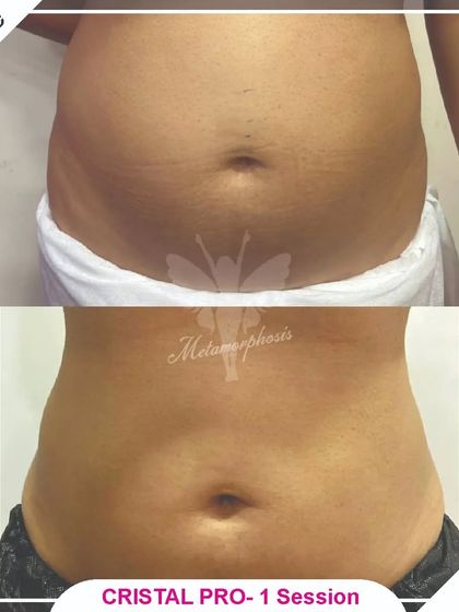 A significant reduction in abdominal fat and a more contoured waistline after a single session with Cristal Pro. This before and after photo demonstrates the power of cryolipolysis for targeted, non-surgical fat removal.