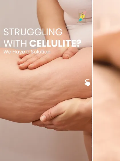 If you are struggling with cellulite, we have a solution. This image shows a common area affected by cellulite, which is a concern for many of my clients. Our treatments are designed to address this directly.