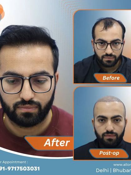 This series shows the full journey: the 'before' state with significant hair loss, the 'post-op' view with freshly implanted grafts, and the final 'after' result with a full, natural head of hair.