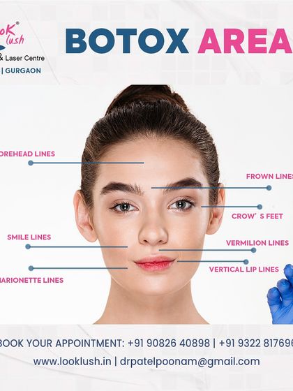 Botox is a safe and effective way to soften dynamic wrinkles. This graphic illustrates the common areas I treat, including forehead lines, frown lines, and crow's feet, to create a smoother, more youthful appearance.