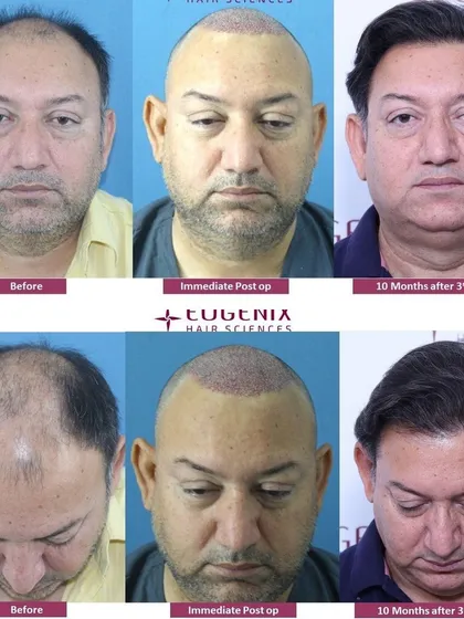 This series of images details a 10-month transformation for a patient with Norwood grade 5V baldness. By meticulously implanting 6,668 grafts over three sittings, we restored the hairline, frontal, mid-scalp, and crown areas.