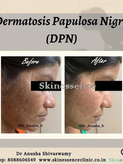 Here is a clear before and after example of Dermatosis Papulosa Nigra (DPN) treatment. These common, harmless growths on the face can be a significant cosmetic concern. Using precise removal techniques, I can achieve clear, smooth skin for my patients, as seen in this transformation.