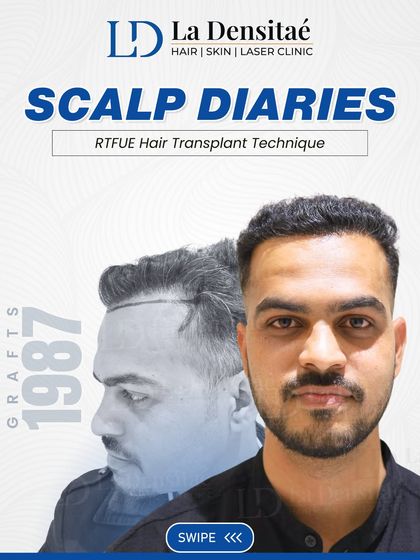This "Scalp Diaries" post highlights Nilesh Shede's journey. The 1,987 grafts were key to restoring his hairline, but his story is also about how much your confidence matters in this process.