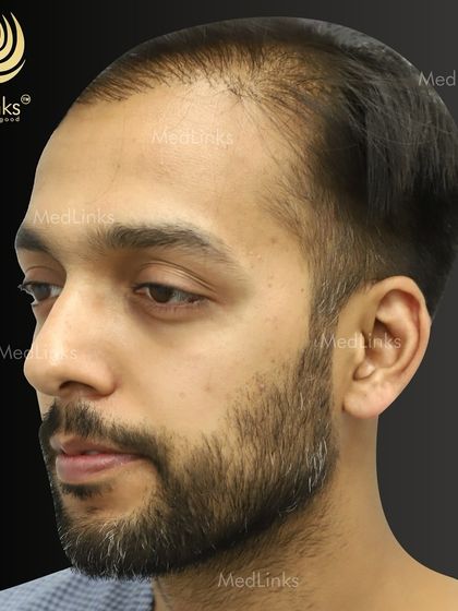 A side view before the procedure, showing the receding hairline. We focus on creating a soft, natural hairline that is age-appropriate and suits the patient's facial structure.