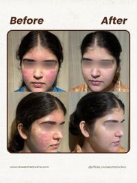 Acne & Scar Treatment