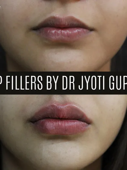 My goal with lip fillers is always enhancement, not exaggeration. This patient wanted fuller, more defined lips that still looked like her own. We achieved a beautifully hydrated and plump result that perfectly complements her natural features.