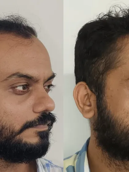 A side profile view is essential to appreciate the artistry of a hairline. Here, you can see how the new hair flows naturally, blending perfectly with his existing hair.