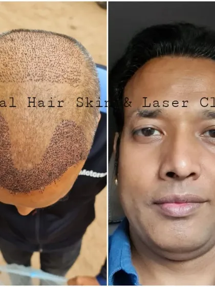 This image shows the journey from the immediate post-procedure stage of an FUE transplant to the final, fully grown result. The outcome is a natural-looking head of hair that blends seamlessly.