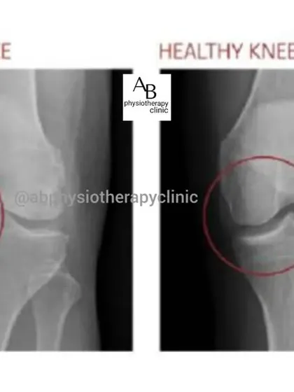 This X-ray comparison clearly shows the difference between a healthy knee joint and one affected by arthritis. You can see the reduced joint space, which is a common cause of pain, stiffness, and reduced mobility that we treat.