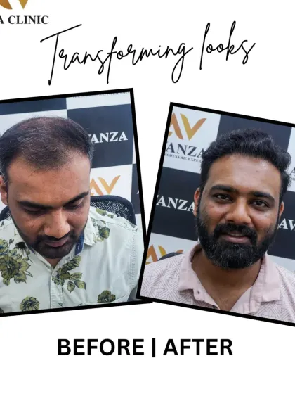 A fantastic transformation that not only restored his hair but also enhanced his overall look with a fuller beard. The result is a sharper, more confident appearance.