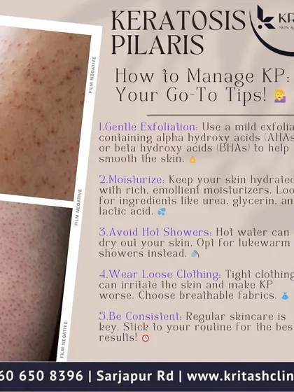 This infographic provides management tips for Keratosis Pilaris, often called 'chicken skin'. This common condition is caused by a buildup of keratin in hair follicles. My approach focuses on gentle exfoliation with AHAs or BHAs and consistent moisturization to smooth the skin's texture.