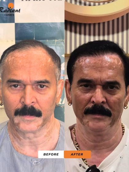 A frontal view of the same patient as image 24. The new hairline is designed to look natural and complements his facial features, completely transforming his appearance.