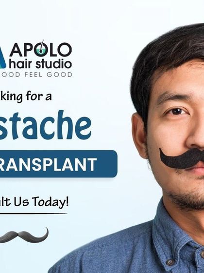 If you are considering a moustache hair transplant, we are here to help. We use advanced techniques like FUE to ensure your new moustache looks and feels like your own hair, giving you a permanent solution for a stronger look.
