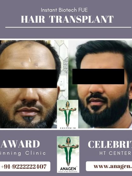 This before and after photo shows another successful hair transplant, with the patient achieving a much fuller and more youthful appearance.