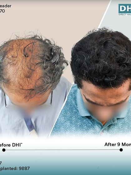 A top-down view of a 47-year-old client 9 months after his procedure. With 9,887 hairs implanted, his scalp is now fully covered with dense, natural-looking hair.