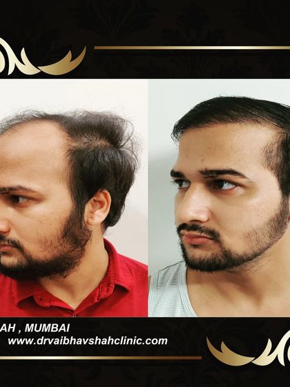 The side profile shows a new, strong hairline that frames the patient's face well.