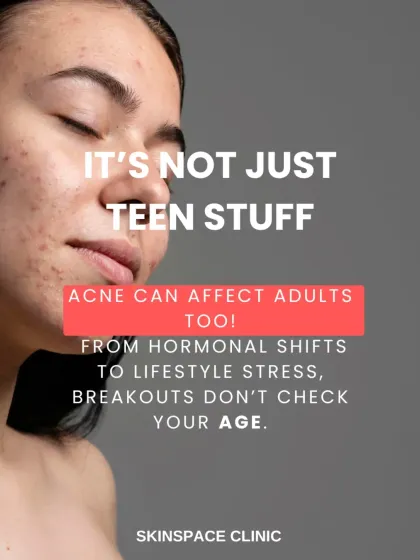 Acne is not just for teenagers. Many adults experience breakouts due to hormonal shifts, stress, and lifestyle factors. Our treatment plans are customized for all ages because we understand the unique triggers behind adult acne.