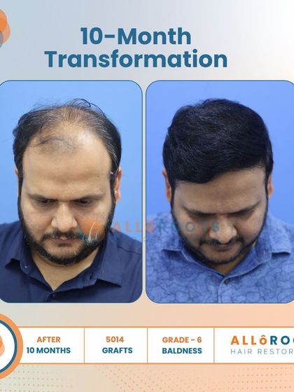 This 10-month transformation is a powerful example of tackling advanced Grade 6 baldness. With 5014 grafts, we achieved remarkable coverage and density, as seen from all angles.