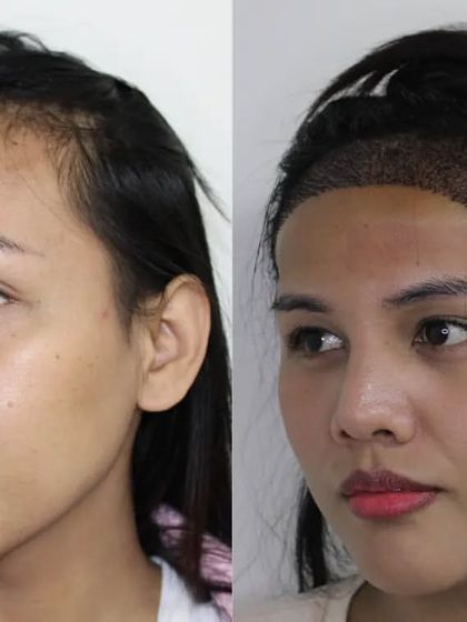 Another angle showing the meticulous placement of the grafts, which is essential for a natural and dense result.