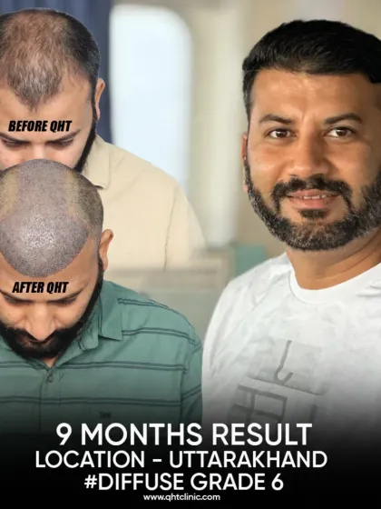 This is a clear look at a 9-month transformation for a patient with Diffuse Grade 6 baldness. Using 4500 grafts, I reconstructed his hairline and restored density to the mid-scalp and crown, achieving a full and natural appearance.