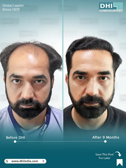 A frontal before and after of the same client 9 months after his procedure. The transformation is striking, with a full, natural hairline that completely changes his look and restores his confidence.