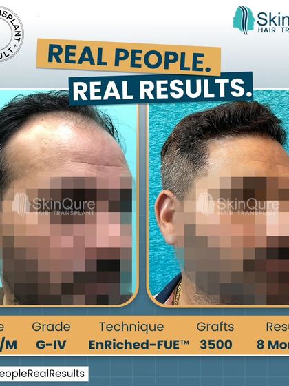 Another side view of the 35-year-old patient's transformation. The result showcases the artistry involved in creating a hairline that is both dense and natural-looking.