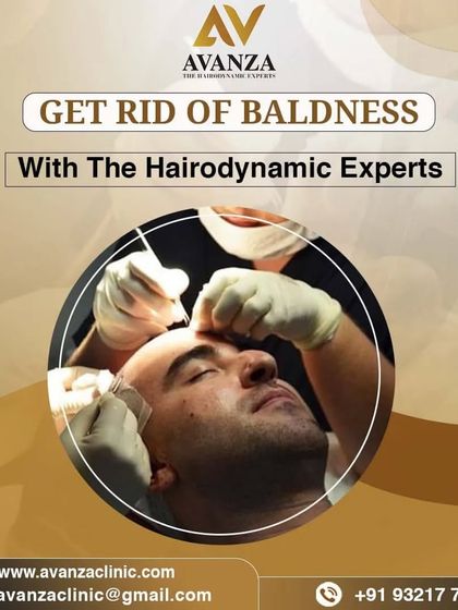 Get rid of baldness with the Hairodynamic Experts. This image shows our surgeons during a procedure, highlighting the focus and precision we bring to every case.