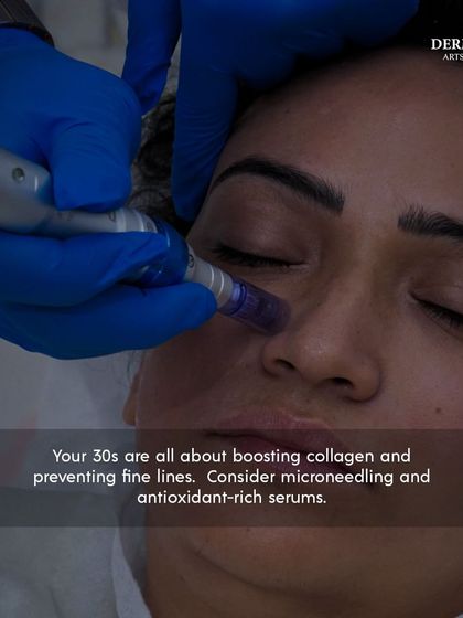 Skincare in your 30s is about boosting collagen and preventing fine lines. This image shows a microneedling treatment, ideal for maintaining youthful skin.