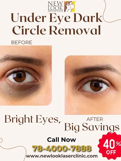 This before-and-after image demonstrates the effectiveness of our under-eye dark circle treatments. We use specialized procedures to brighten the delicate under-eye area, reducing tiredness and creating a more vibrant look.