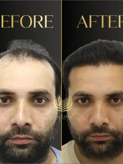 This before and after shot clearly demonstrates the power of a well-executed hair transplant. The patient looks younger, and his expression shows a renewed sense of confidence.