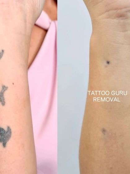 These three bird silhouettes on the forearm have been faded significantly. Depending on the client's goal, some choose to stop at this stage for a cover-up, while others continue to full removal.
