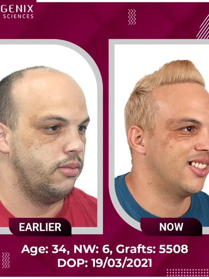 The full head hair transplant results for an international patient, showcasing a complete change with 5508 grafts.