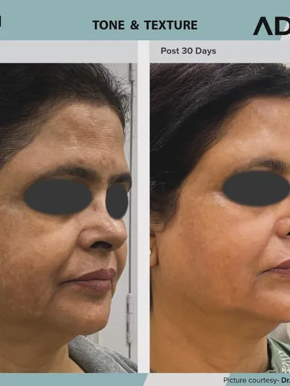 This before and after comparison shows how AdvaTx can address pigmentation and uneven skin tone. The skin is visibly clearer and more uniform after 30 days.