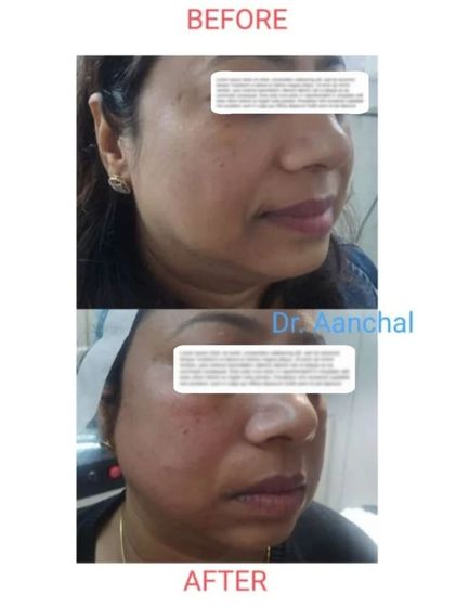 This image shows the instant results of a threadlift procedure. The 'after' photo, taken immediately post-treatment, displays a visible lift and tightening of the lower face and jowls.