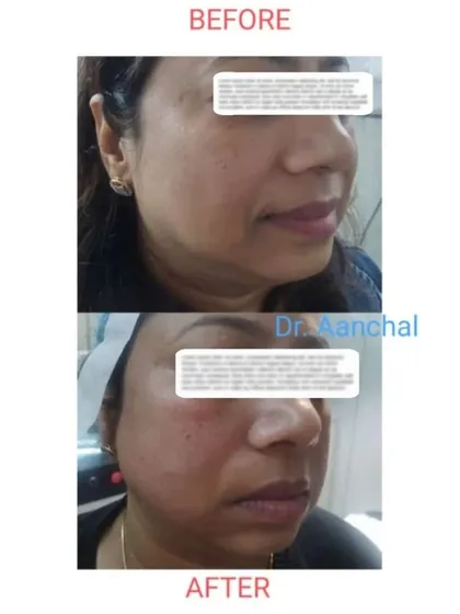 This image shows the instant results of a threadlift procedure. The 'after' photo, taken immediately post-treatment, displays a visible lift and tightening of the lower face and jowls.