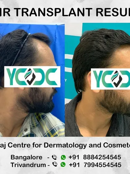 A three-quarter view that effectively shows the restored density and the natural angle of the transplanted hair, blending seamlessly.
