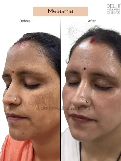 Melasma, often called the "pregnancy mask," can be a persistent concern. This before and after showcases a significant reduction in patchy pigmentation, resulting in a much more even and radiant complexion. I focus on safe treatments that deliver real, visible change.