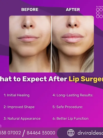 This before-and-after image demonstrates the subtle yet significant impact of lip surgery. My focus is on creating a natural-looking enhancement that restores volume and improves shape, ensuring the results are in perfect harmony with your overall facial features.
