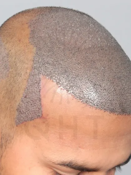 A Diffuse Grade 5A transformation begins with 5850 grafts. We recreated the hairline, frontal part, mid-scalp, and temples.