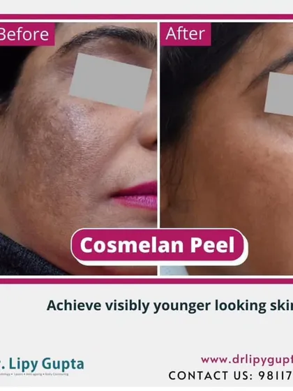 Stubborn pigmentation and uneven skin tone can be frustrating. This before-and-after showcases the result of a Cosmelan Peel, a professional depigmentation treatment I use to target melasma and sun damage at its source for clearer, brighter skin.