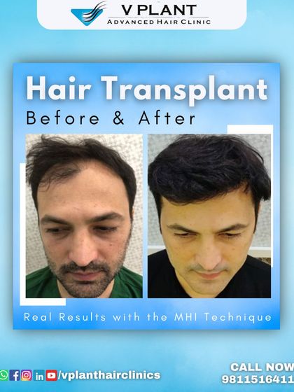 Real results achieved with our signature MHI technique. Notice the natural density and the well-designed hairline that frames the face, creating a more youthful and confident appearance.