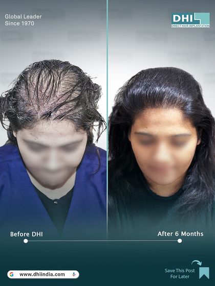 A frontal before and after of the 28-year-old female client. The restored hairline and fuller look have given her a renewed sense of confidence just 6 months after her hair transplant.