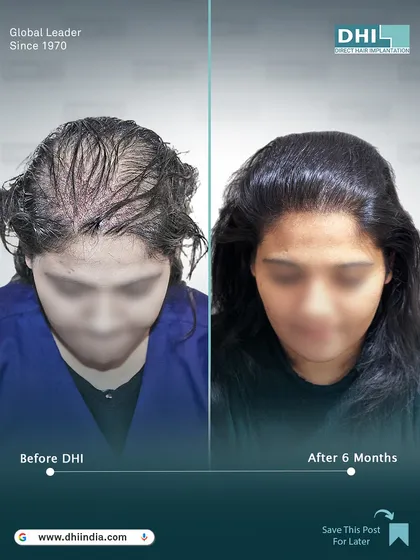 A frontal before and after of the 28-year-old female client. The restored hairline and fuller look have given her a renewed sense of confidence just 6 months after her hair transplant.
