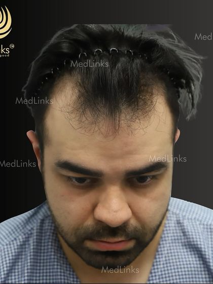 A top-down view of the patient's hair loss before the transplant.
