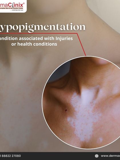 An image showing Hypopigmentation, a condition where patches of skin become lighter than the surrounding skin, often associated with injuries or health conditions.