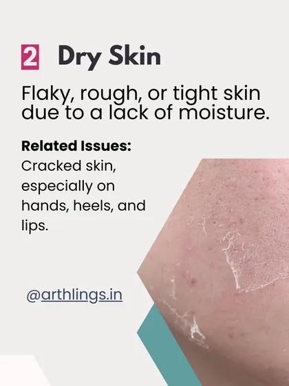 Dry skin feels flaky, rough, or tight due to a lack of moisture. This can lead to cracked skin, especially on the hands, heels, and lips.