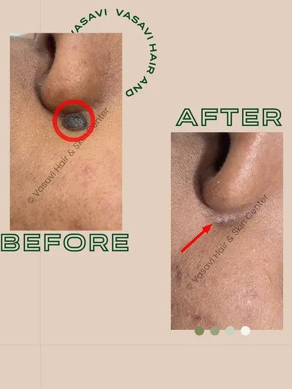 This before-and-after shows the successful removal of a mole located next to the nose. My technique ensures the mole is fully excised while preserving the natural skin texture and avoiding any noticeable scarring in a prominent facial area.