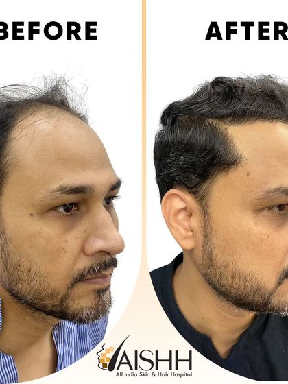 This patient's result highlights the power of a well-executed hair transplant. We restored his receding hairline and added density throughout the frontal region, achieving a much more youthful appearance.