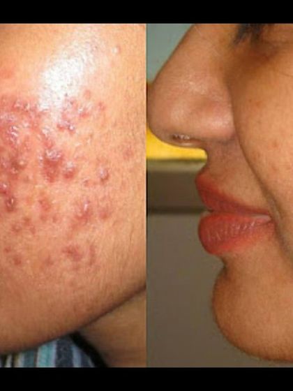 This side-profile before-and-after demonstrates the effectiveness of my acne treatment protocols, resulting in clearer skin and a significant boost in the patient's confidence.