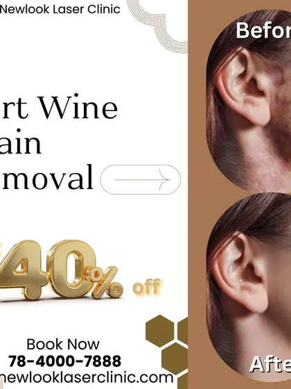 See the transformative results of our Port Wine Stain removal treatment. This before and after comparison highlights the significant improvement possible with our advanced laser procedures.